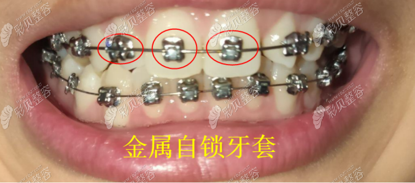 金属自锁牙套