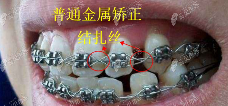 普通金属牙套