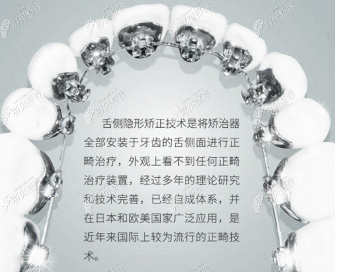 舌侧矫正只做前面八个可以么