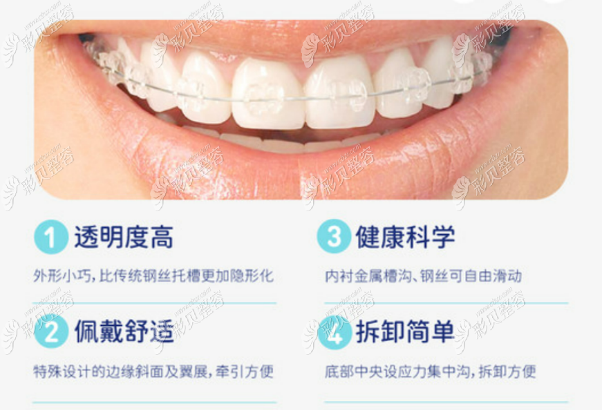 半隐形牙套