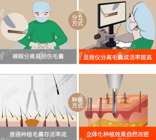 植发医院提取毛囊的流程