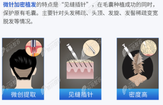 微针植发技术介绍