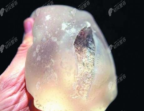 说下隆胸假体取出后胸会好难看吗毕竟我的隆胸假体已取出