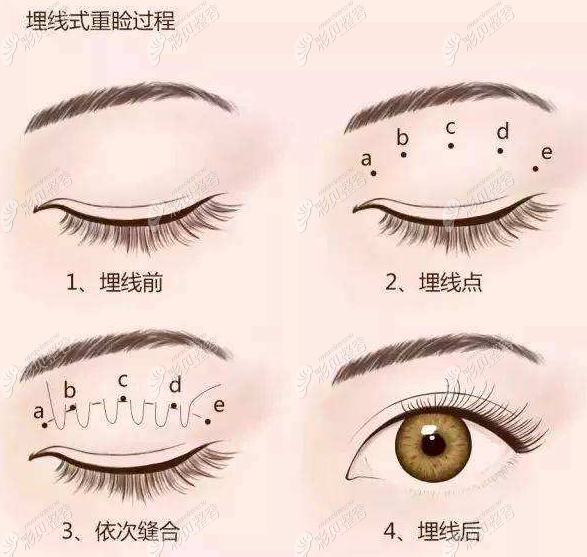 咨询上海哪些医院做埋线双眼皮好,非公办医院做完会留疤吗