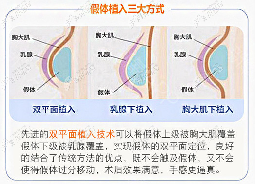 银川华美做假体隆胸的植入方式