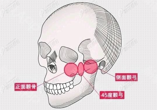 3D颧骨旋转术会下垂吗