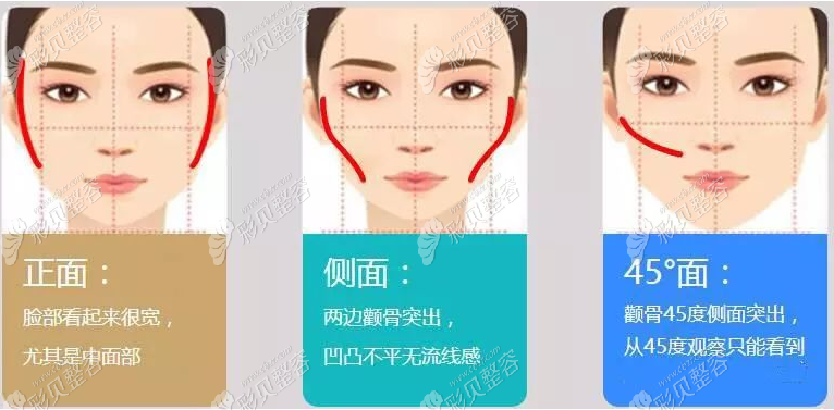 3d颧骨旋转术和颧骨内推有什么区别
