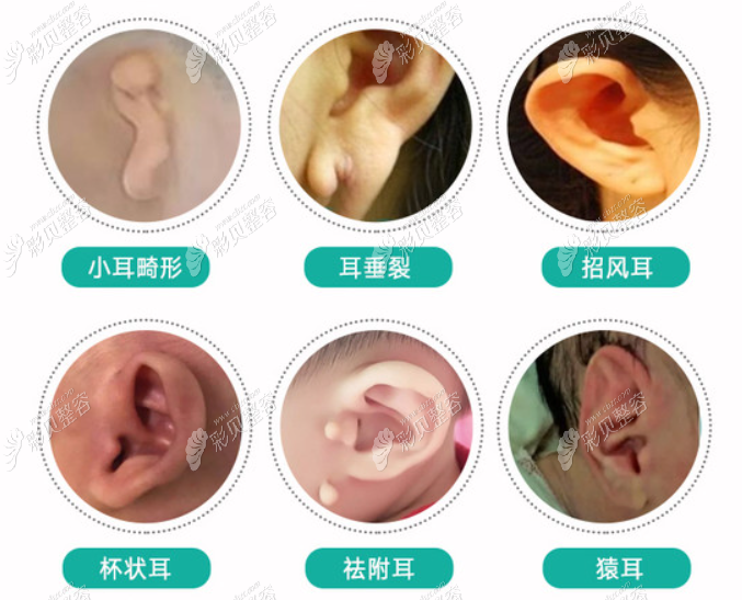 耳朵畸形种类有哪些