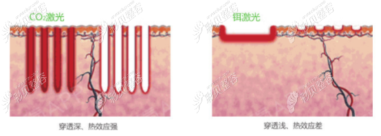 菲蜜丽和欧洲之星蕊丽紧致去黑哪个好,做一次能保持几个月