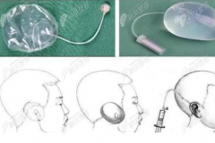耳朵畸形几种正确修复方法中,肋骨直埋手术和全包法哪个好
