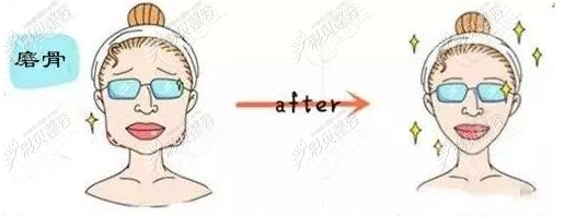 磨骨瘦脸手术前后对比