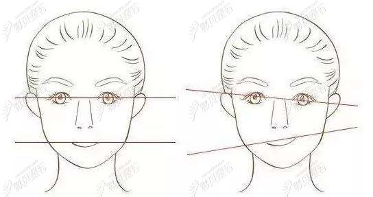 脸歪下颌骨不对称怎么办