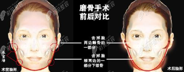 磨骨手术过程对比图
