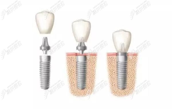 种植牙由种植体、基台和牙冠组成