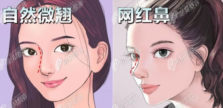 自然鼻和网红鼻的区别