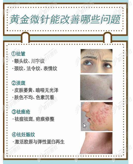 黄金射频微针功效