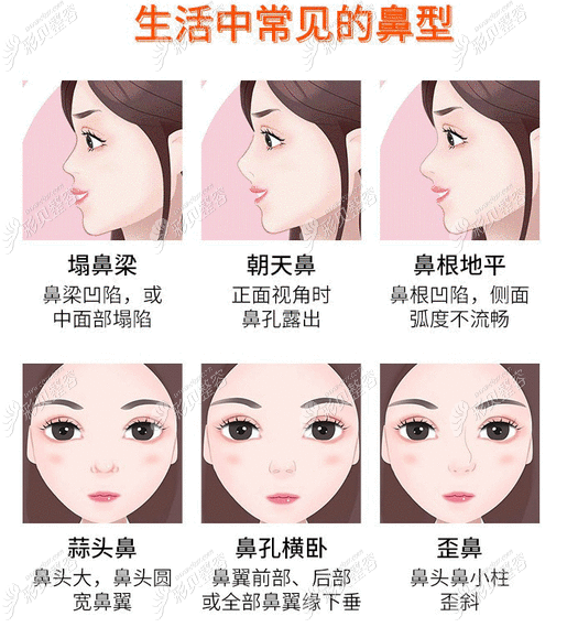 鼻整形常见的类型