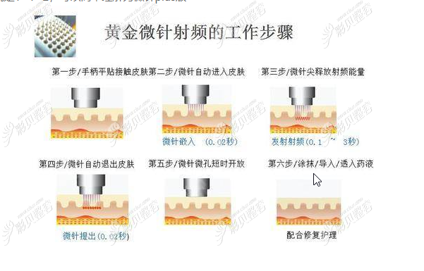 黄金射频微针步骤
