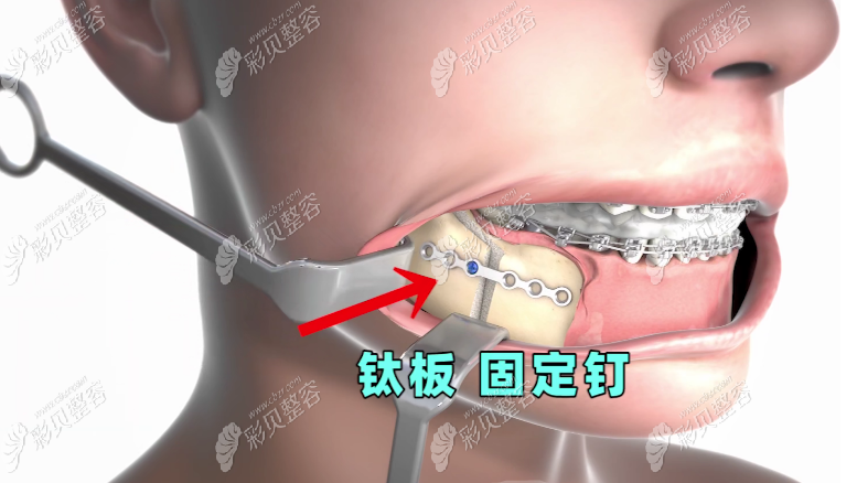 重度前翘的话,可以通过正颌手术矫正 重度前翘的话,可以通过正颌手术矫正