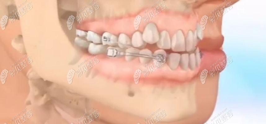 轻微前翘的话,可以通过牙齿矫正 轻微前翘的话,可以通过牙齿矫正