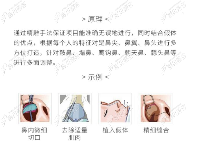 广元市硅胶假体隆鼻价格表，进口假体比国产假体贵那么多