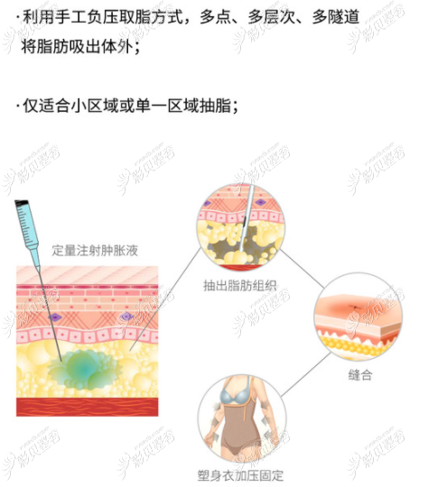 肿胀液也带麻醉成分减少手臂吸脂过程中的疼痛