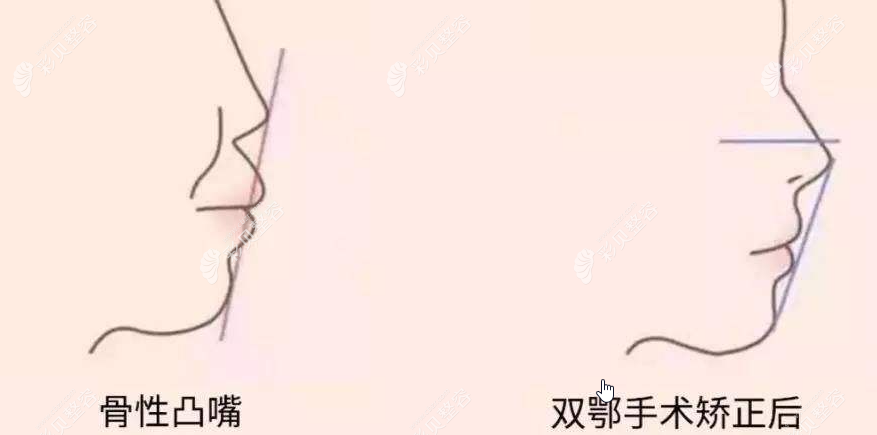 想知道骨性凸嘴正颌矫正手术费用，40多岁龅牙突出能不能做