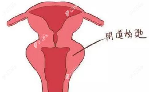 私处松弛做3d生物束带紧缩术能缩到几指?做完会越来越紧吗?