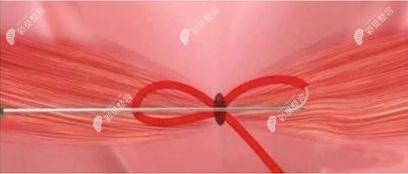 3d生物束带紧缩术手术原理示意图