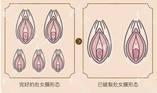 梅州曙光整形医院处女膜修复的价格，不预约能当天做么？