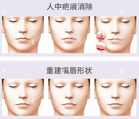 传统唇腭裂手术修复过程图解