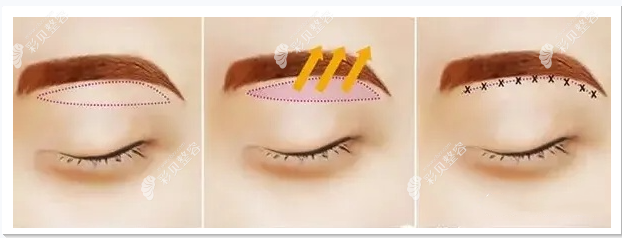 提眉手术过程cbzr.com