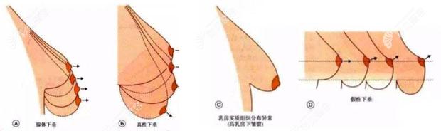 双环法乳房悬吊术多少钱跟胸下垂提升手术难度有关