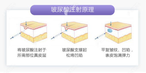 怎么注射玻尿酸