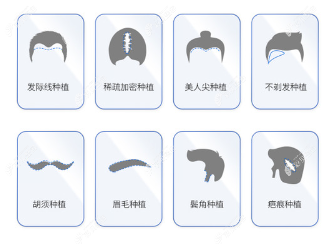现在国内有哪些比较成熟的植发技术