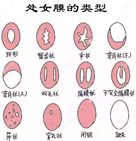 处女膜修复后还会出血吗