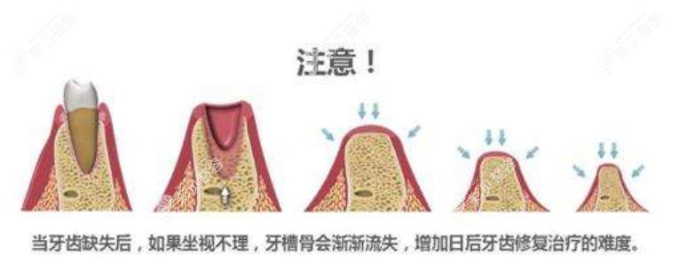全口牙槽骨缺失很多能修补回来做种植牙吗？