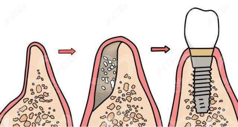 全口牙槽骨缺失很多能修补回来做种植牙吗？能