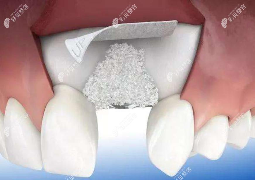 全口牙槽骨缺失很多能修补回来做种植牙