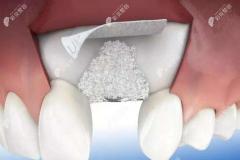 全口牙槽骨缺失很多能修补回来做种植牙吗？