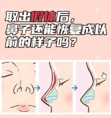 取出隆鼻假体后能恢复原来样子