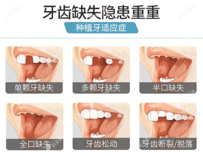 广东省免费种植牙活动是真的