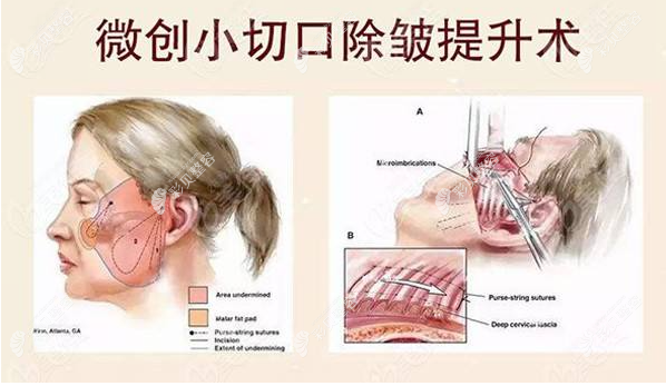 小切口拉皮手术过程图