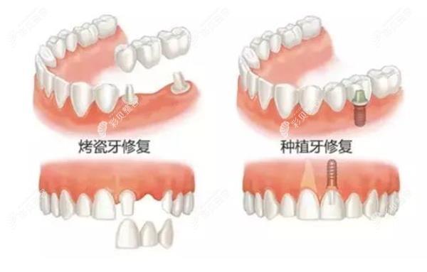 80岁老年人做烤瓷牙和种植牙哪个好