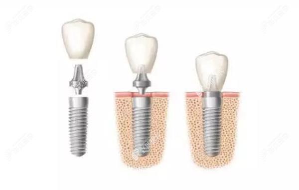种植牙过程图解