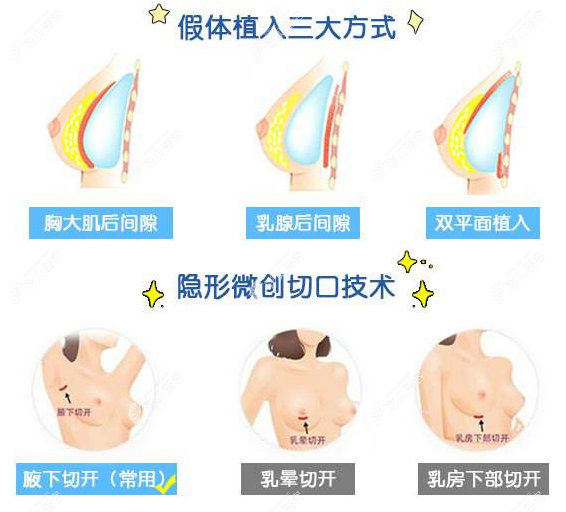 假体植入的方式和切口