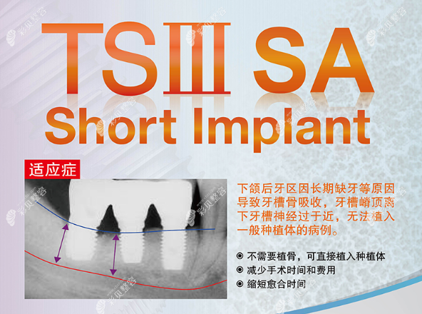 奥齿泰TSⅢ超短型号种植体图片