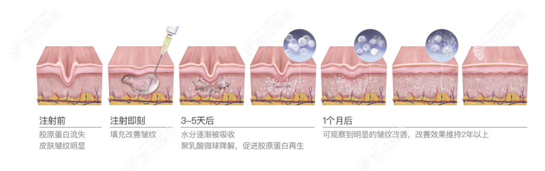 艾维岚主要注射部位