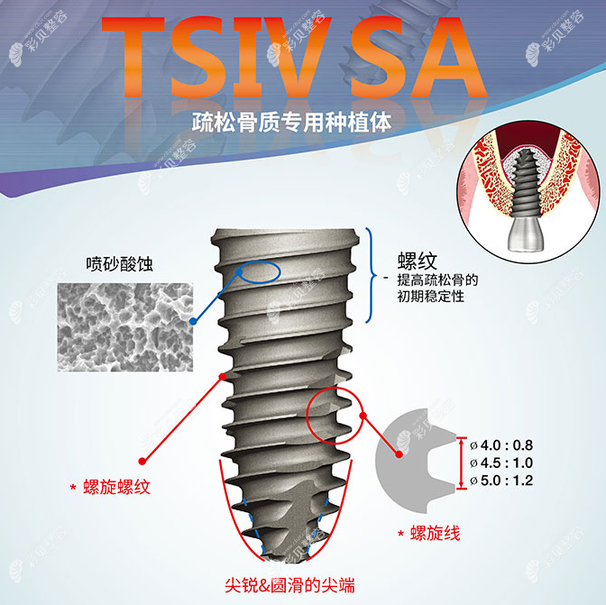 奥齿泰种植体TSIV SA型号图片