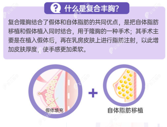 郭杰医生做复合隆胸的优势